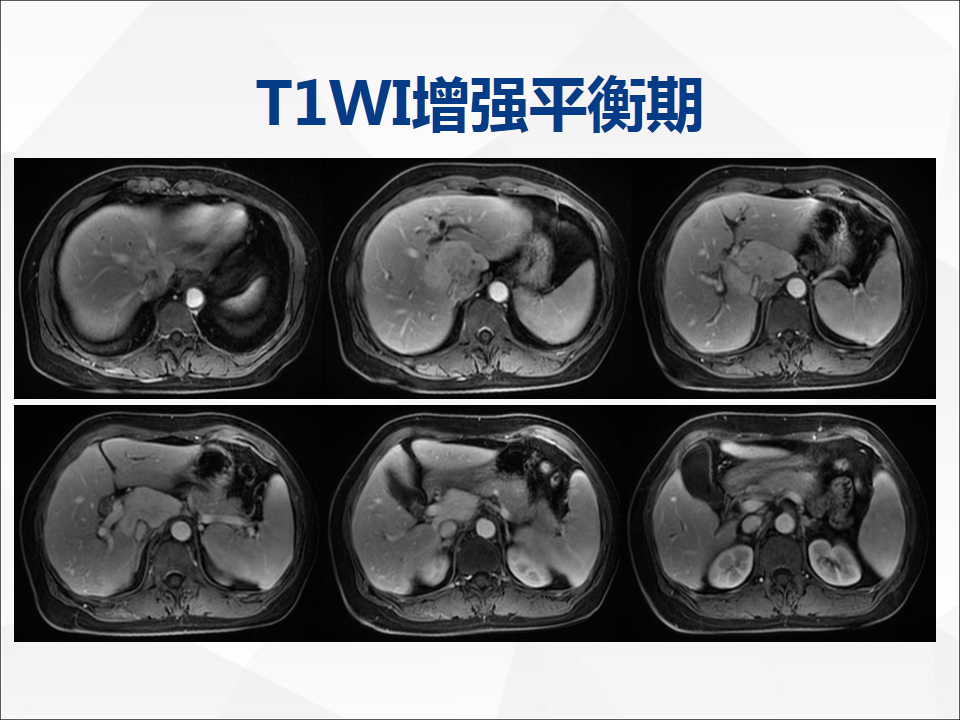 影像PPT - 【病例】肝脏胆管细胞癌1例CT及MR影像-13