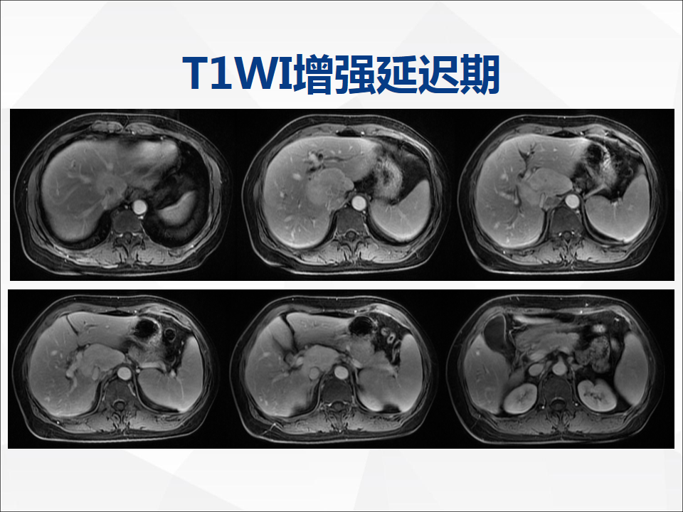 影像PPT - 【病例】肝脏胆管细胞癌1例CT及MR影像-14