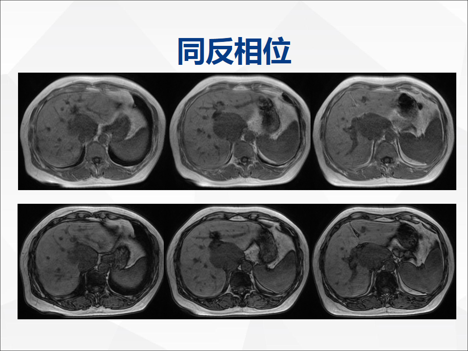 影像PPT - 【病例】肝脏胆管细胞癌1例CT及MR影像-15