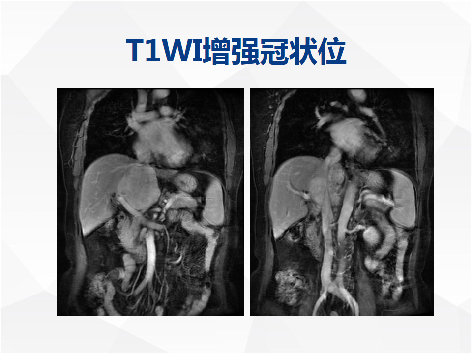 影像PPT - 【病例】肝脏胆管细胞癌1例CT及MR影像-16
