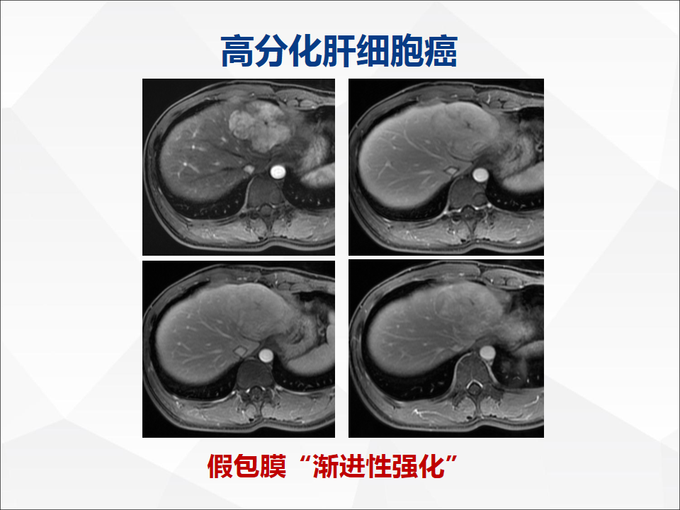 影像PPT - 【病例】肝脏胆管细胞癌1例CT及MR影像-23