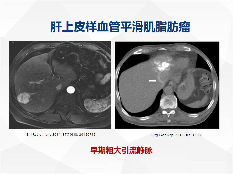 影像PPT - 【病例】肝脏胆管细胞癌1例CT及MR影像-24