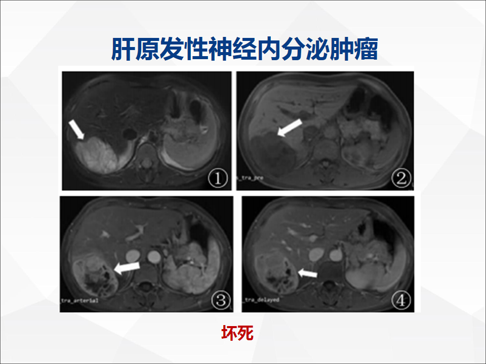影像PPT - 【病例】肝脏胆管细胞癌1例CT及MR影像-26