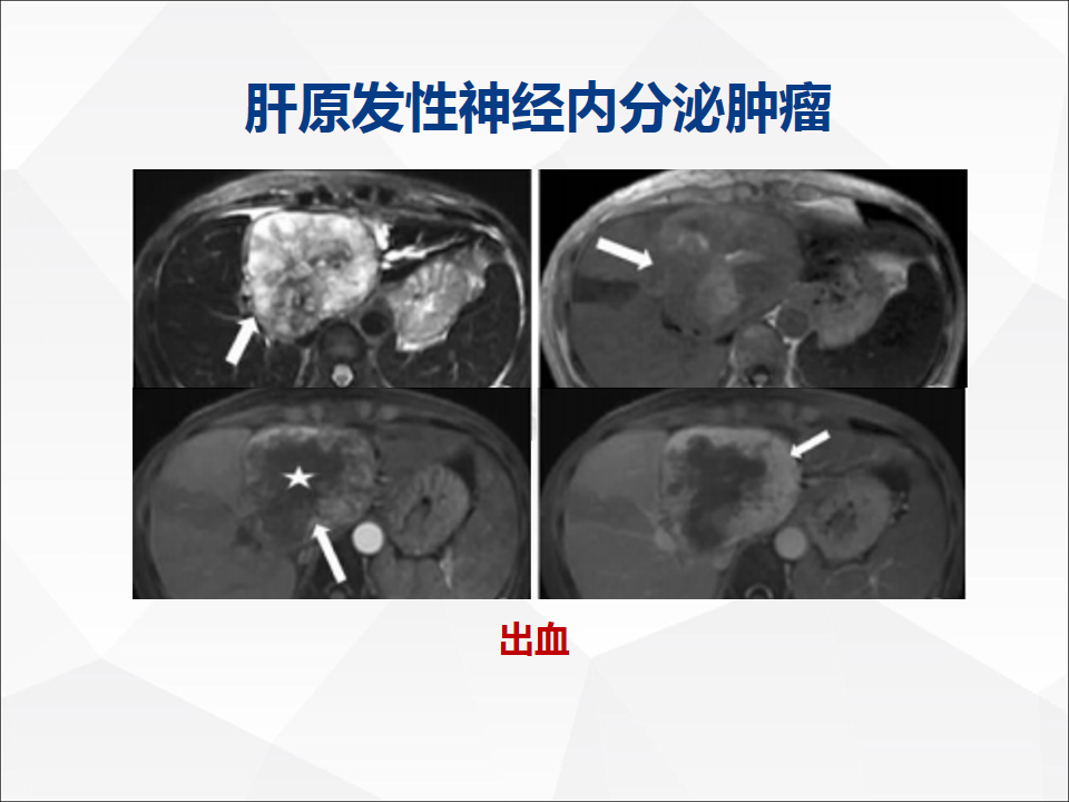 影像PPT - 【病例】肝脏胆管细胞癌1例CT及MR影像-27