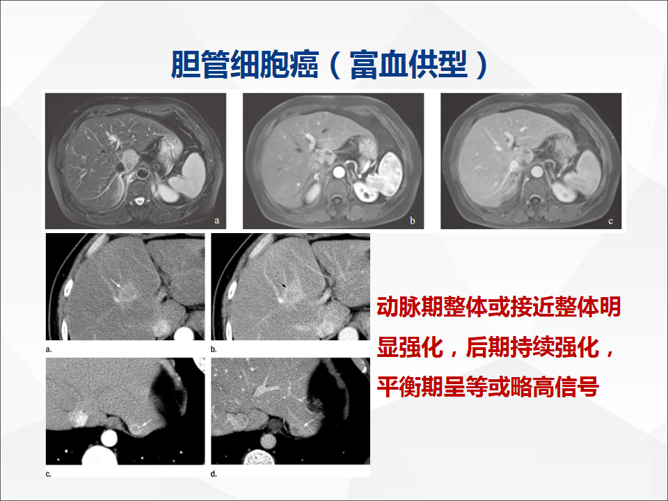 影像PPT - 【病例】肝脏胆管细胞癌1例CT及MR影像-30