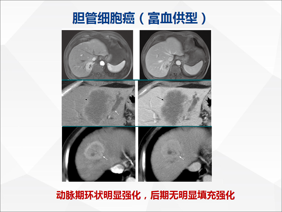 影像PPT - 【病例】肝脏胆管细胞癌1例CT及MR影像-31