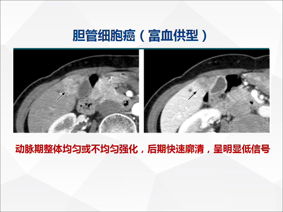 影像PPT - 【病例】肝脏胆管细胞癌1例CT及MR影像-32