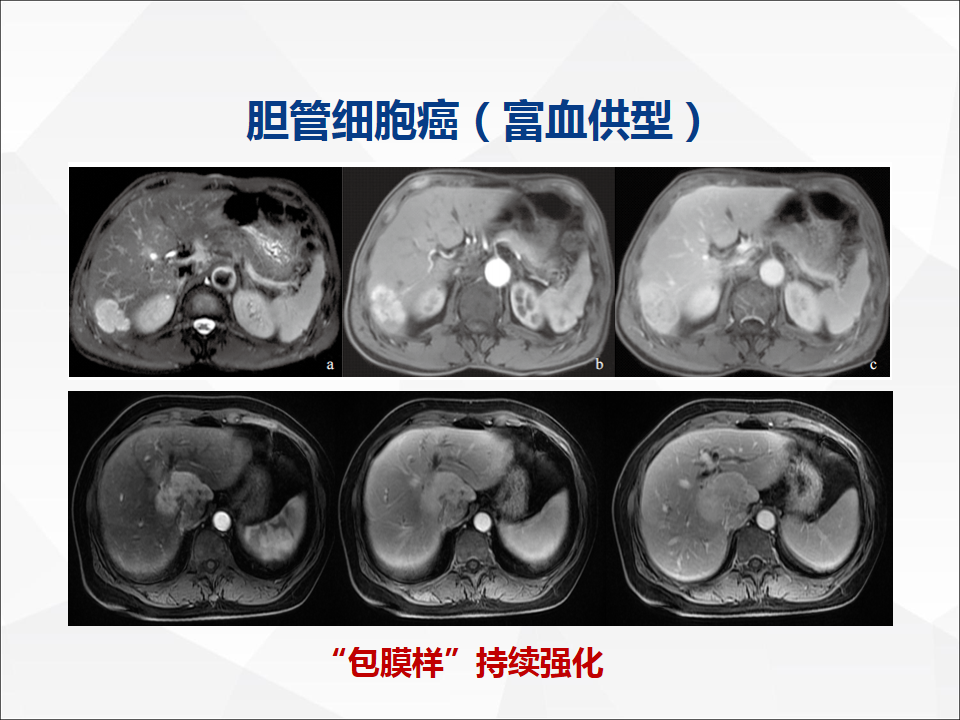影像PPT - 【病例】肝脏胆管细胞癌1例CT及MR影像-33