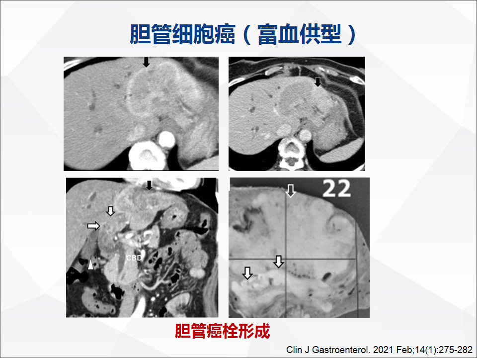 影像PPT - 【病例】肝脏胆管细胞癌1例CT及MR影像-34