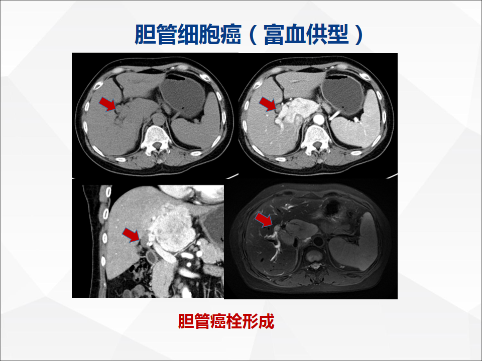 影像PPT - 【病例】肝脏胆管细胞癌1例CT及MR影像-35
