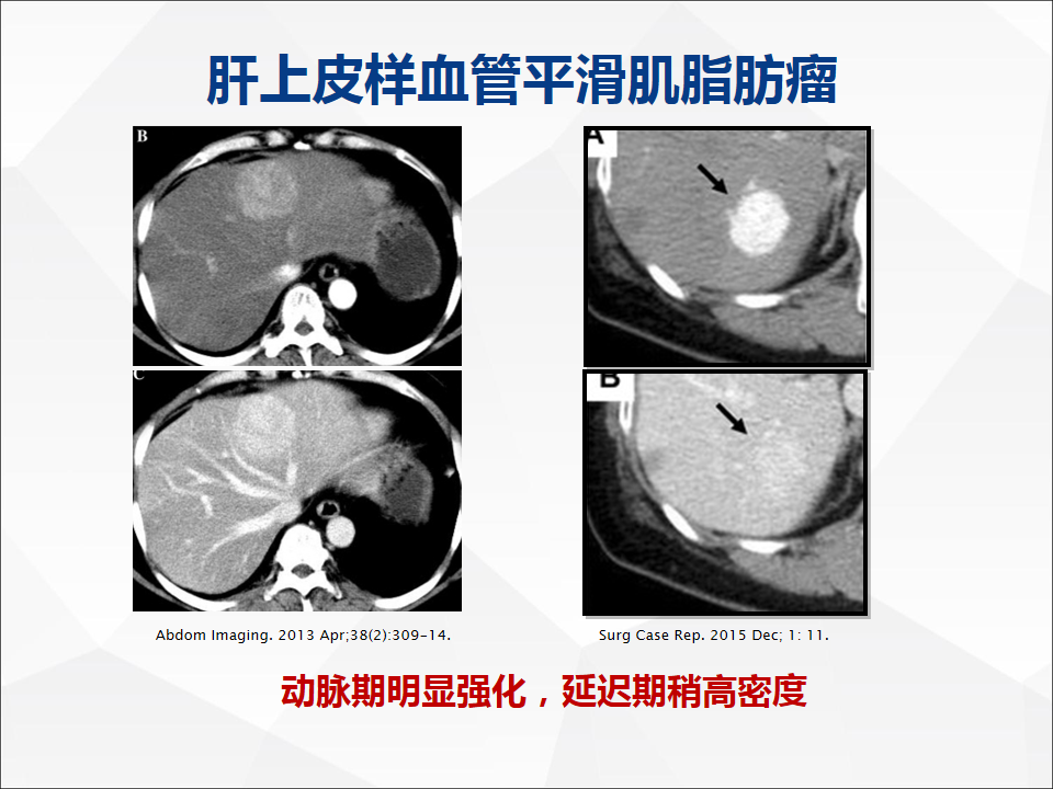 影像PPT - 【病例】肝脏胆管细胞癌1例CT及MR影像-39