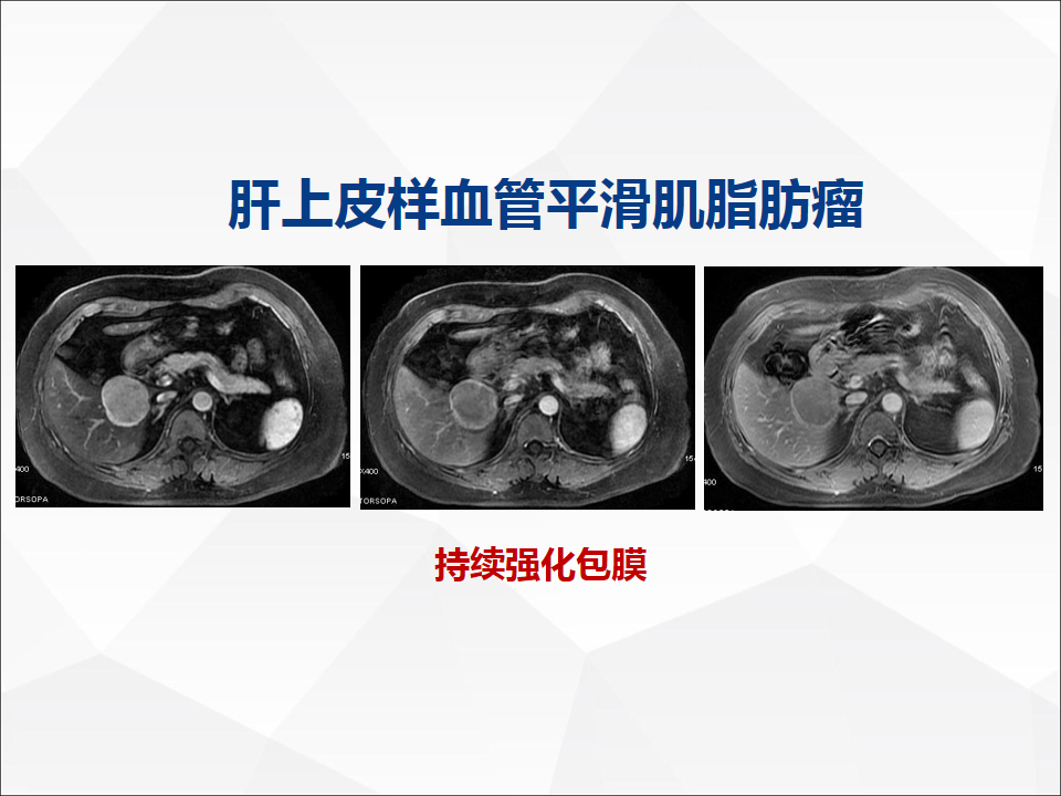 影像PPT - 【病例】肝脏胆管细胞癌1例CT及MR影像-40