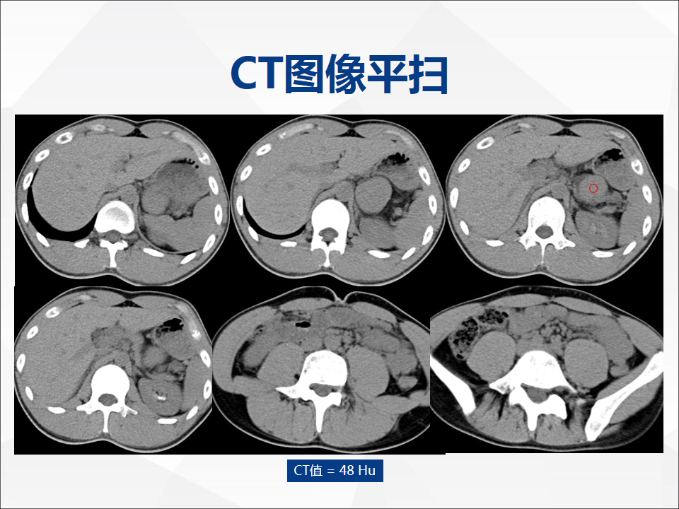 影像PPT - 【病例】附脾伴蒂扭转1例CT影像-3