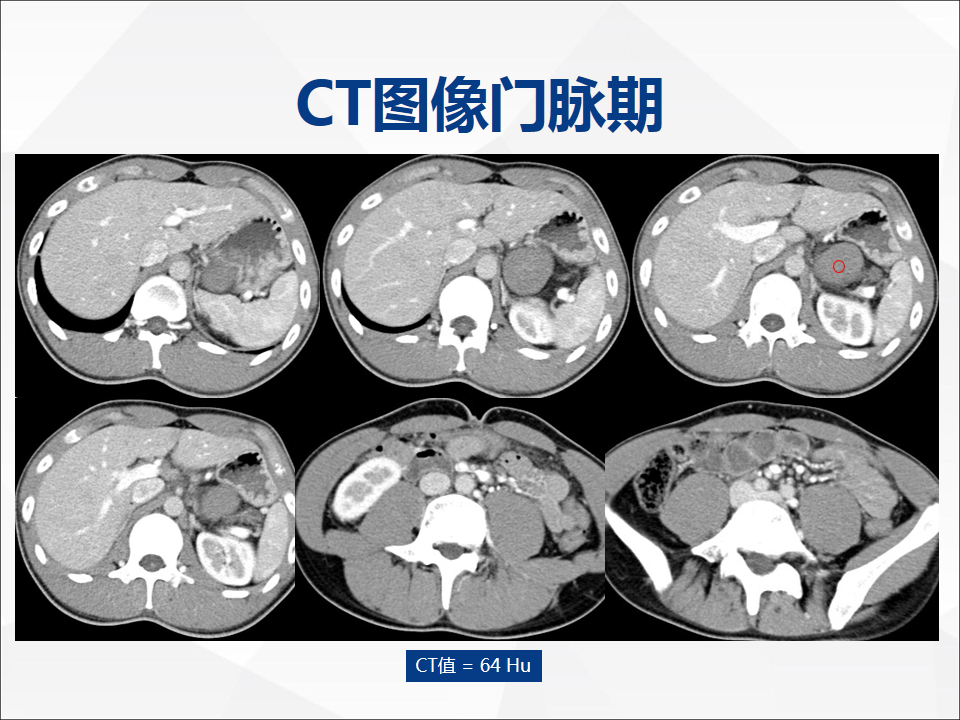 影像PPT - 【病例】附脾伴蒂扭转1例CT影像-4