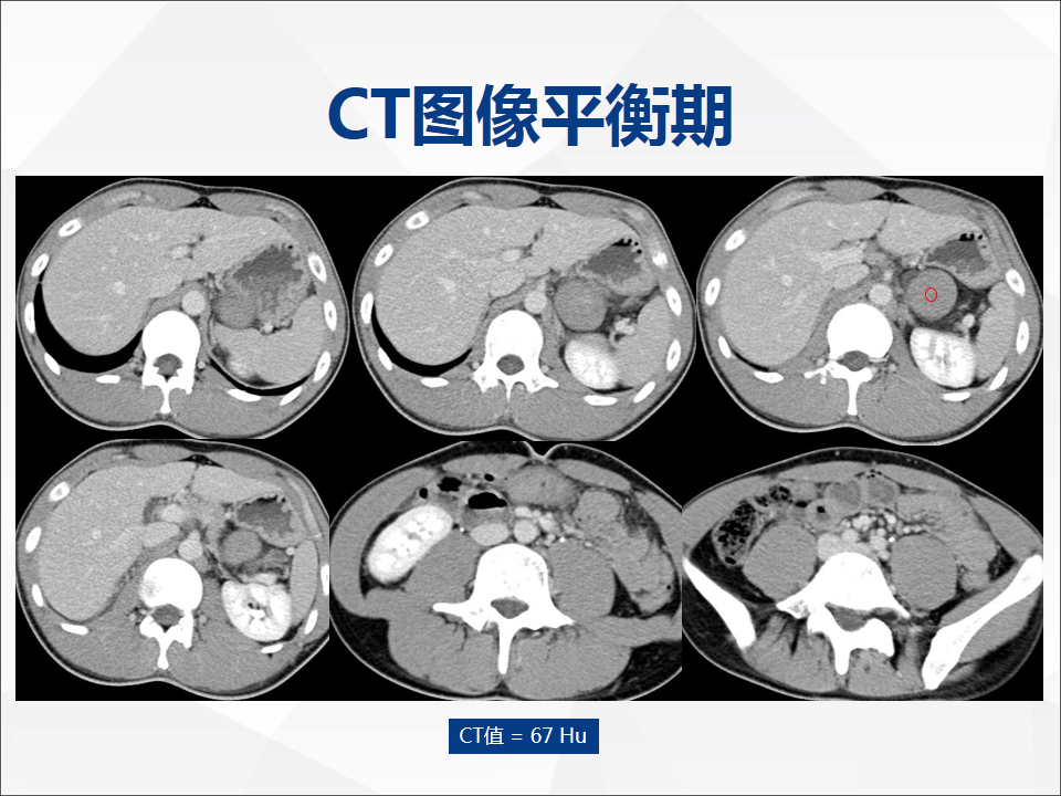 影像PPT - 【病例】附脾伴蒂扭转1例CT影像-5