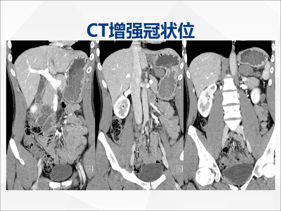 影像PPT - 【病例】附脾伴蒂扭转1例CT影像-6