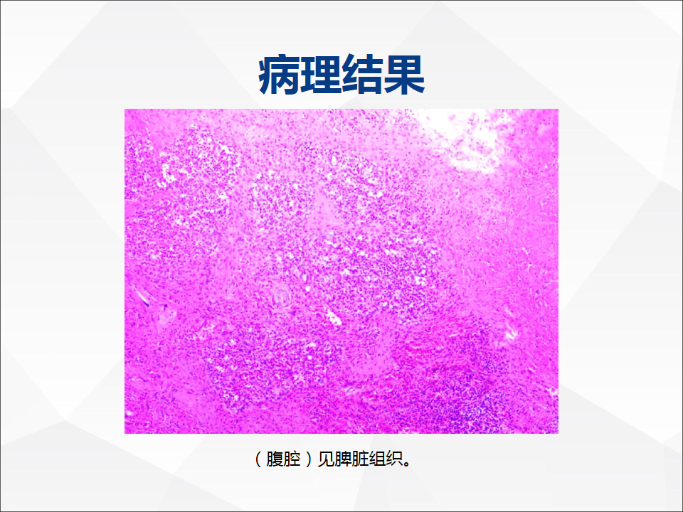 影像PPT - 【病例】附脾伴蒂扭转1例CT影像-8