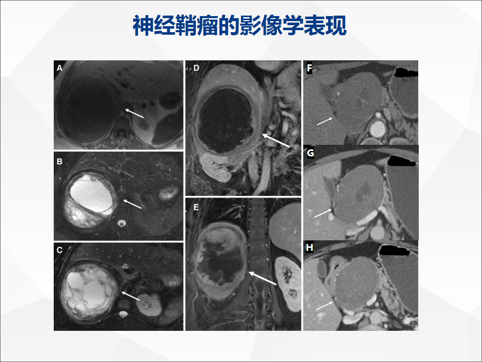 影像PPT - 【病例】附脾伴蒂扭转1例CT影像-13