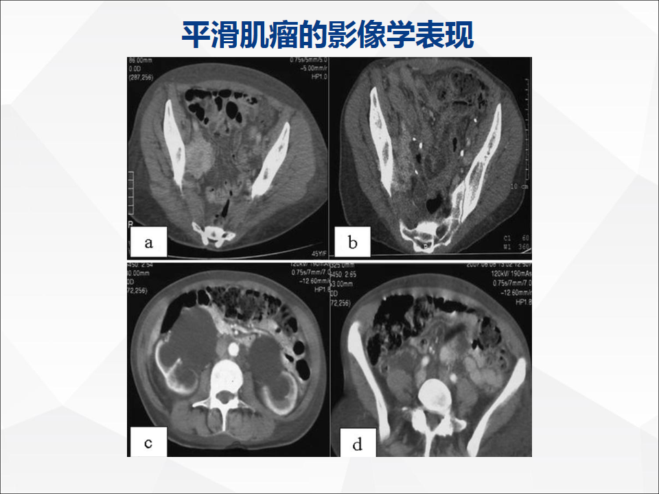 影像PPT - 【病例】附脾伴蒂扭转1例CT影像-15