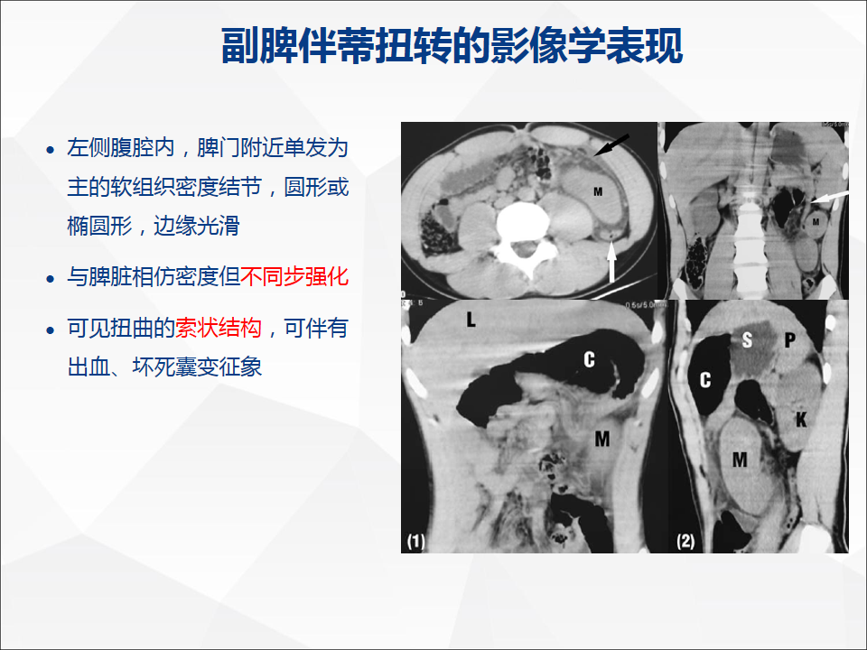 影像PPT - 【病例】附脾伴蒂扭转1例CT影像-20