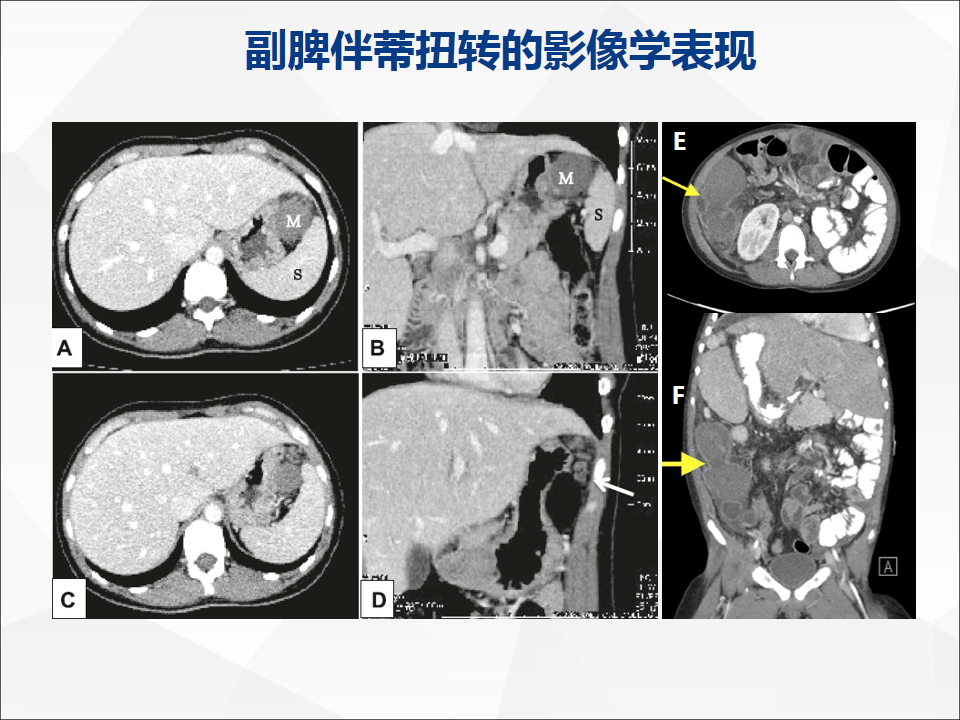 影像PPT - 【病例】附脾伴蒂扭转1例CT影像-21