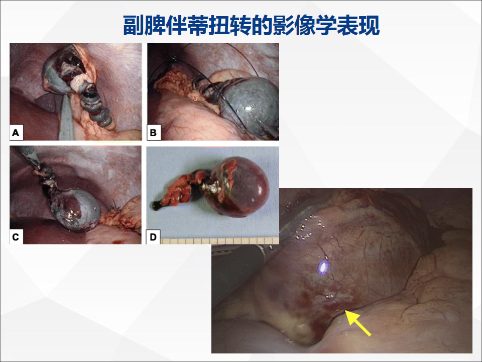 影像PPT - 【病例】附脾伴蒂扭转1例CT影像-22