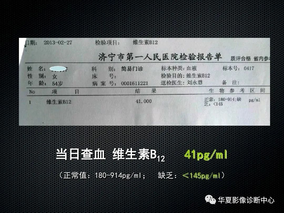 影像PPT - 【PPT】脊髓亚急性联合变性的MRI诊断-16
