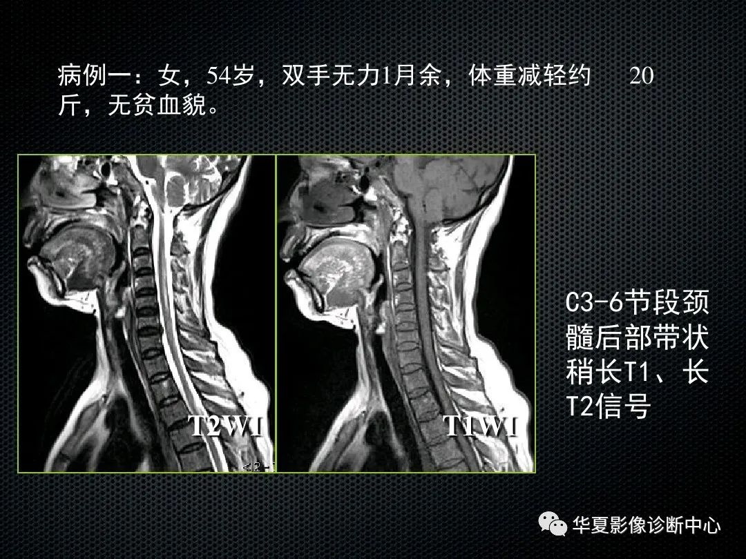 影像PPT - 【PPT】脊髓亚急性联合变性的MRI诊断-14