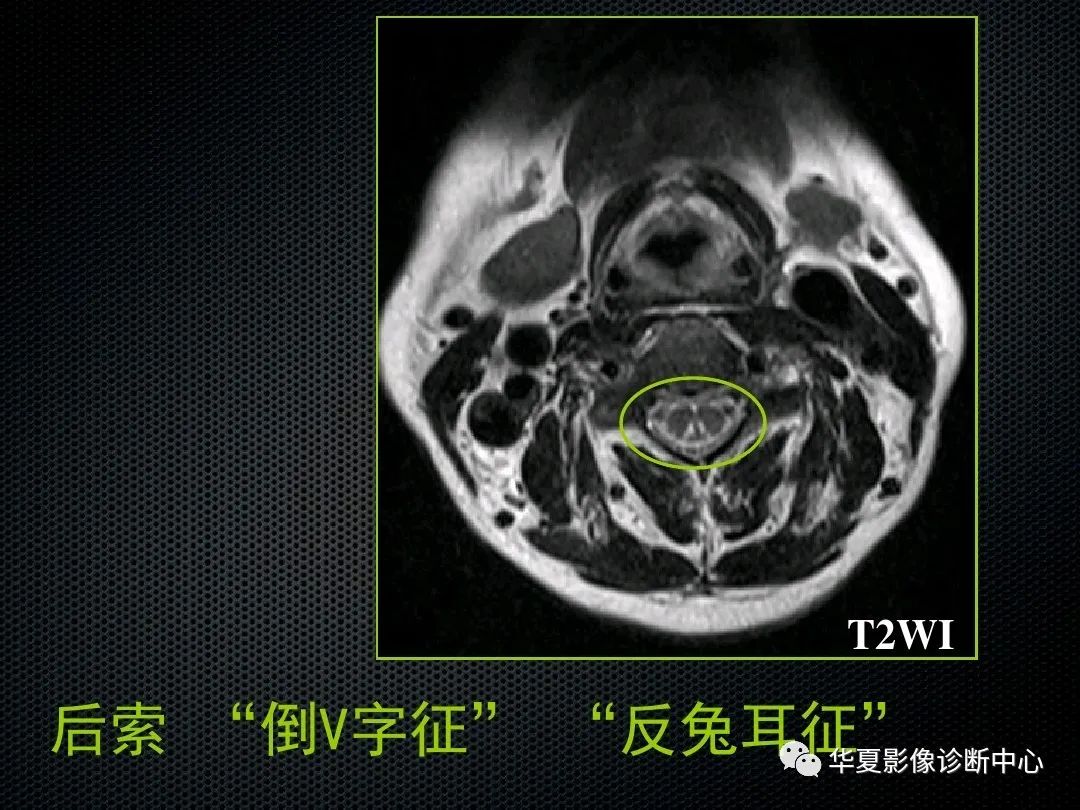 影像PPT - 【PPT】脊髓亚急性联合变性的MRI诊断-15