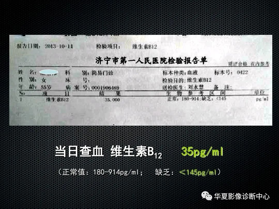 影像PPT - 【PPT】脊髓亚急性联合变性的MRI诊断-18