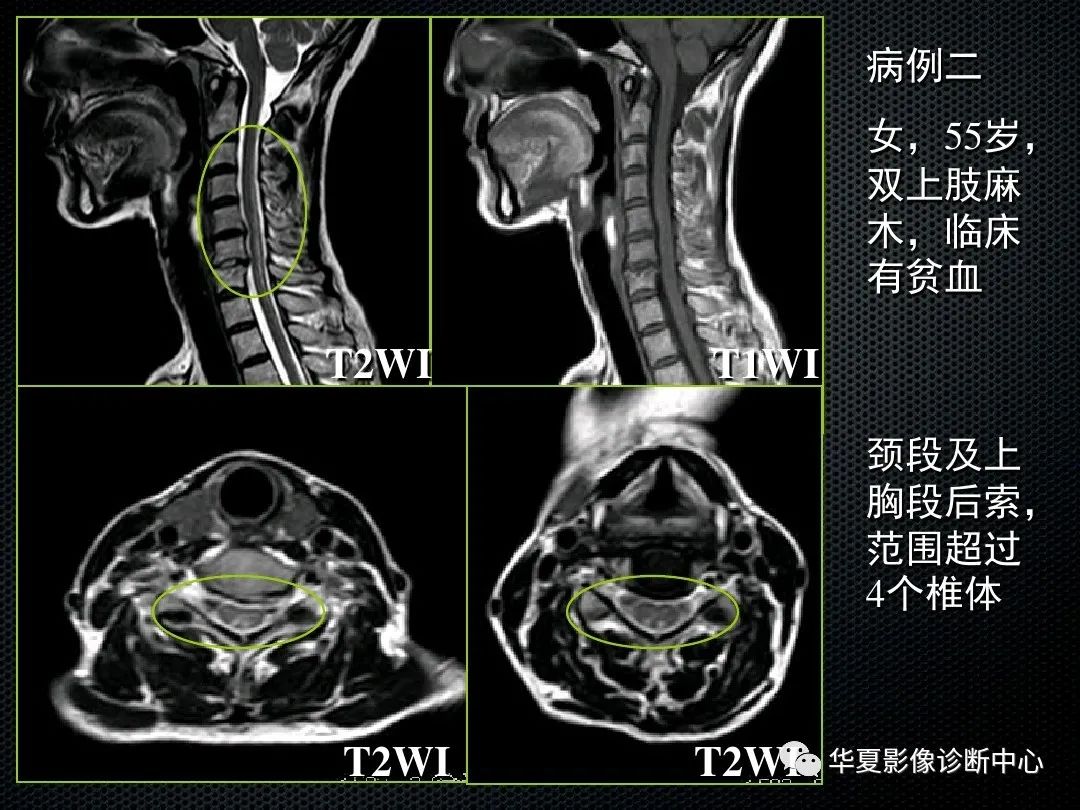 影像PPT - 【PPT】脊髓亚急性联合变性的MRI诊断-17