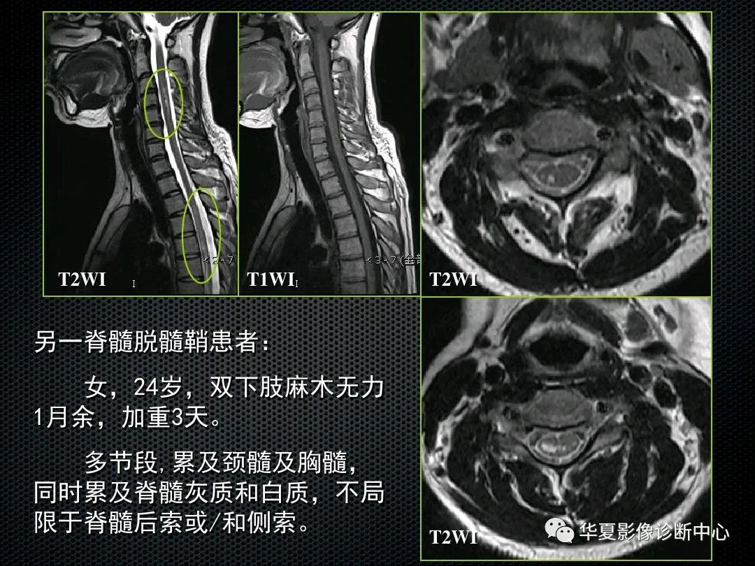 影像PPT - 【PPT】脊髓亚急性联合变性的MRI诊断-22