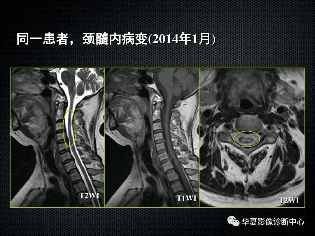 影像PPT - 【PPT】脊髓亚急性联合变性的MRI诊断-21
