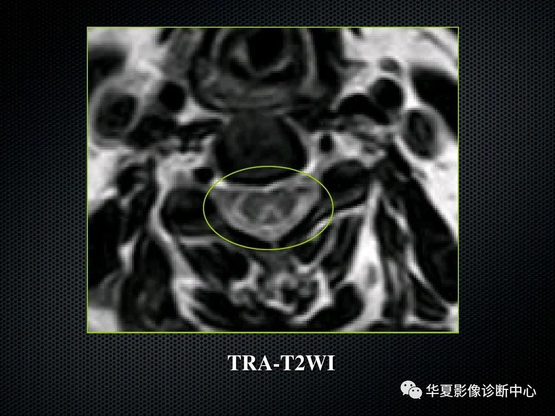 影像PPT - 【PPT】脊髓亚急性联合变性的MRI诊断-19
