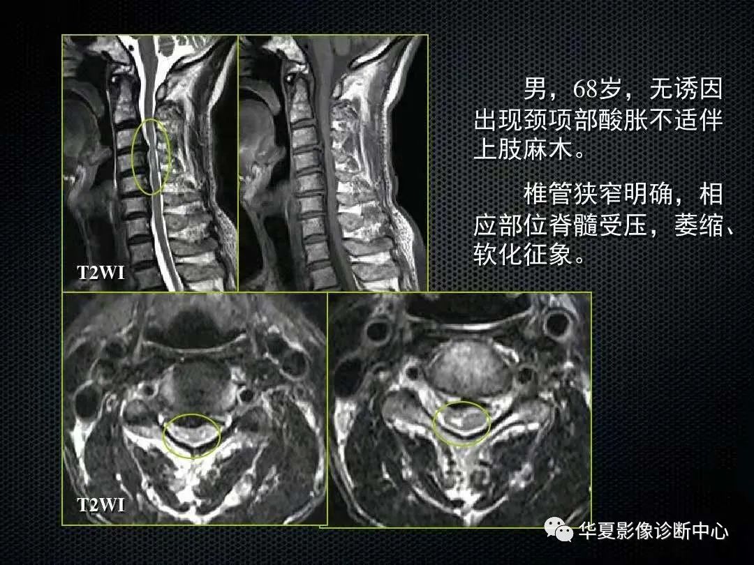 影像PPT - 【PPT】脊髓亚急性联合变性的MRI诊断-24