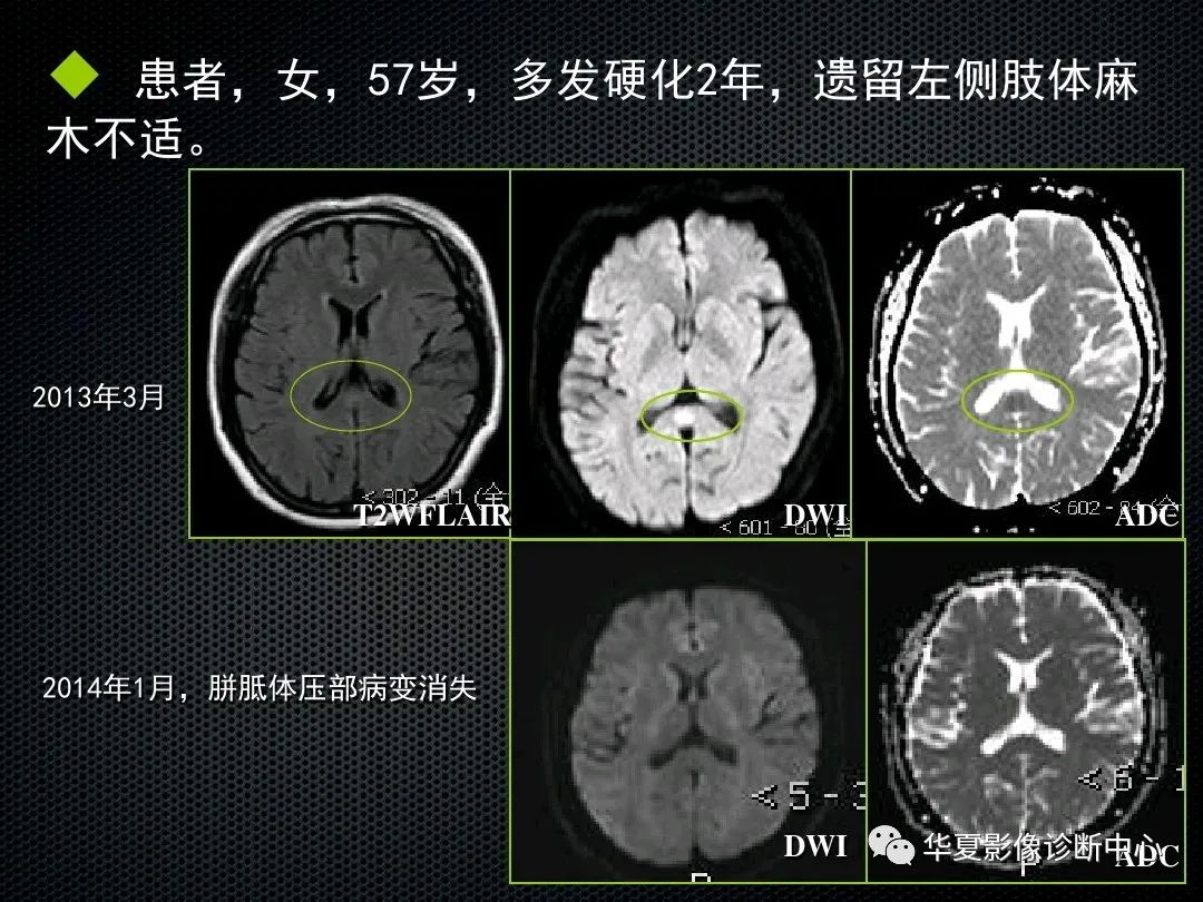 影像PPT - 【PPT】脊髓亚急性联合变性的MRI诊断-20