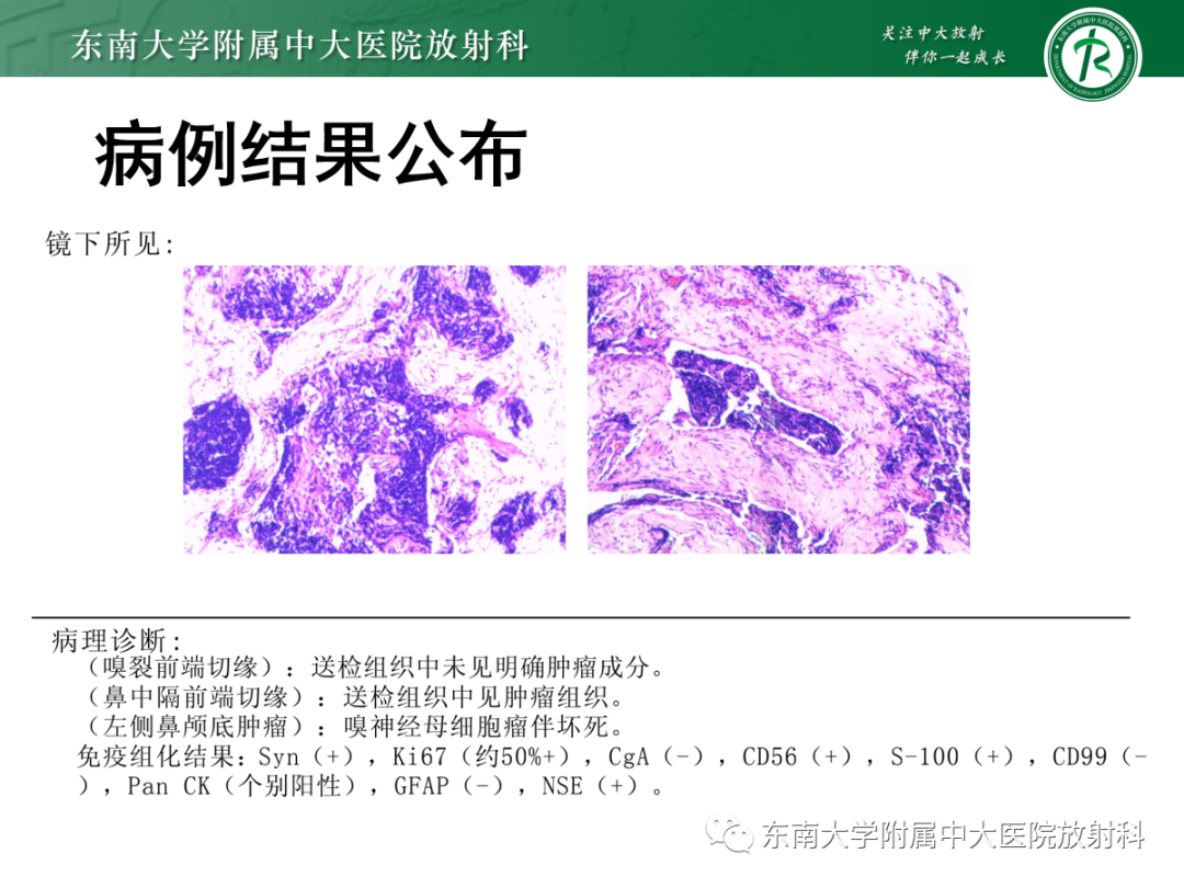 影像PPT - 【PPT】嗅神经母细胞瘤-3