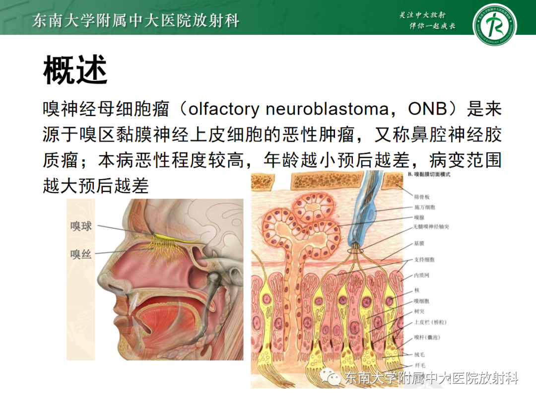 影像PPT - 【PPT】嗅神经母细胞瘤-8