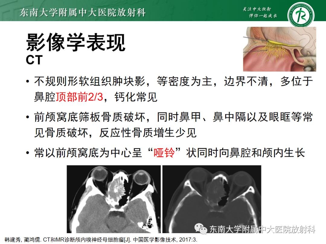 影像PPT - 【PPT】嗅神经母细胞瘤-12