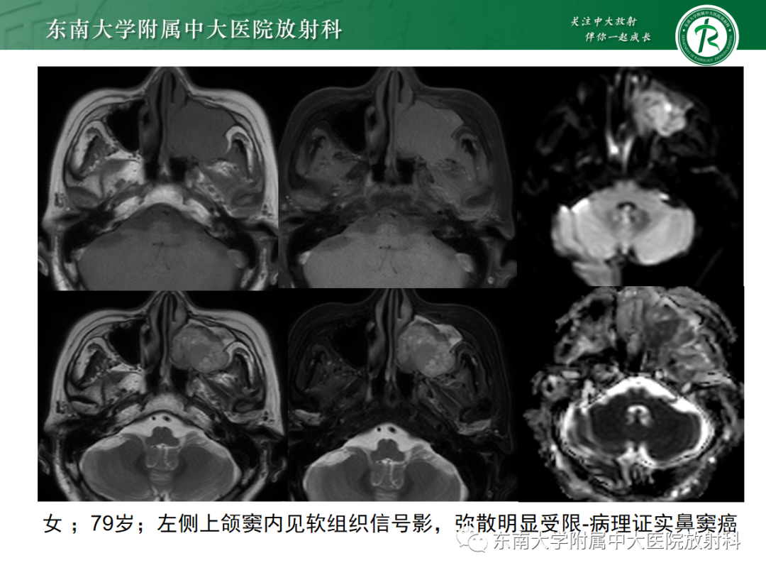影像PPT - 【PPT】嗅神经母细胞瘤-15