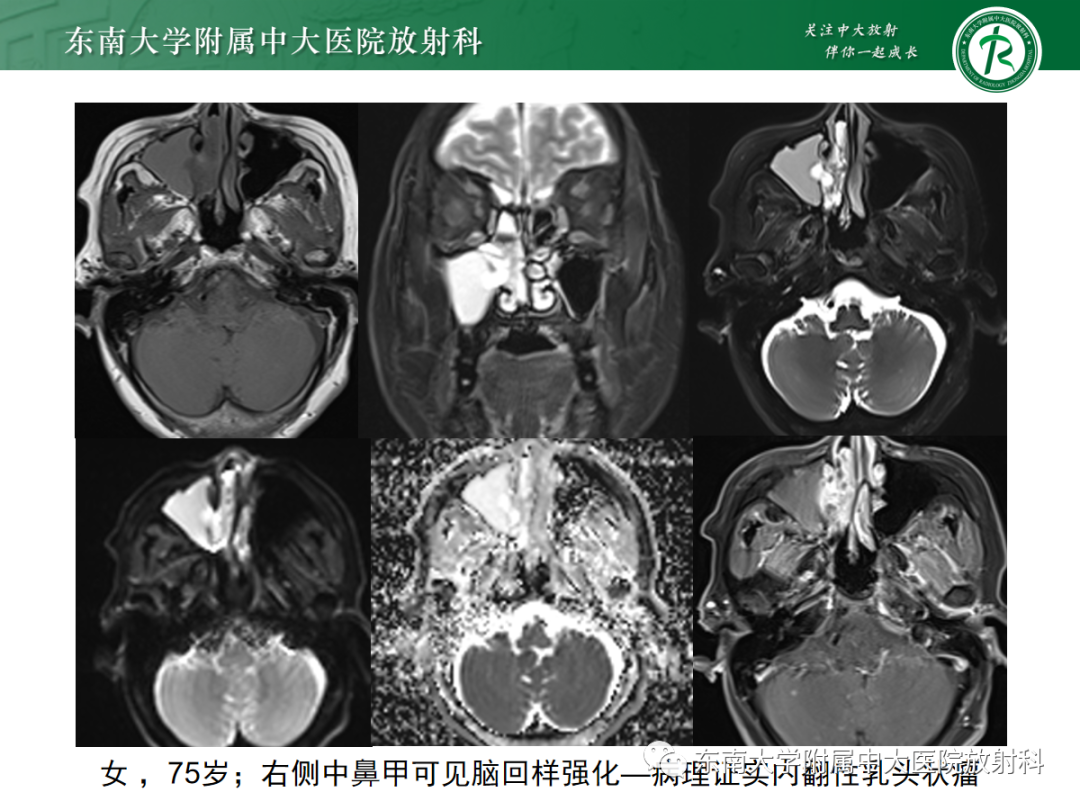 影像PPT - 【PPT】嗅神经母细胞瘤-21