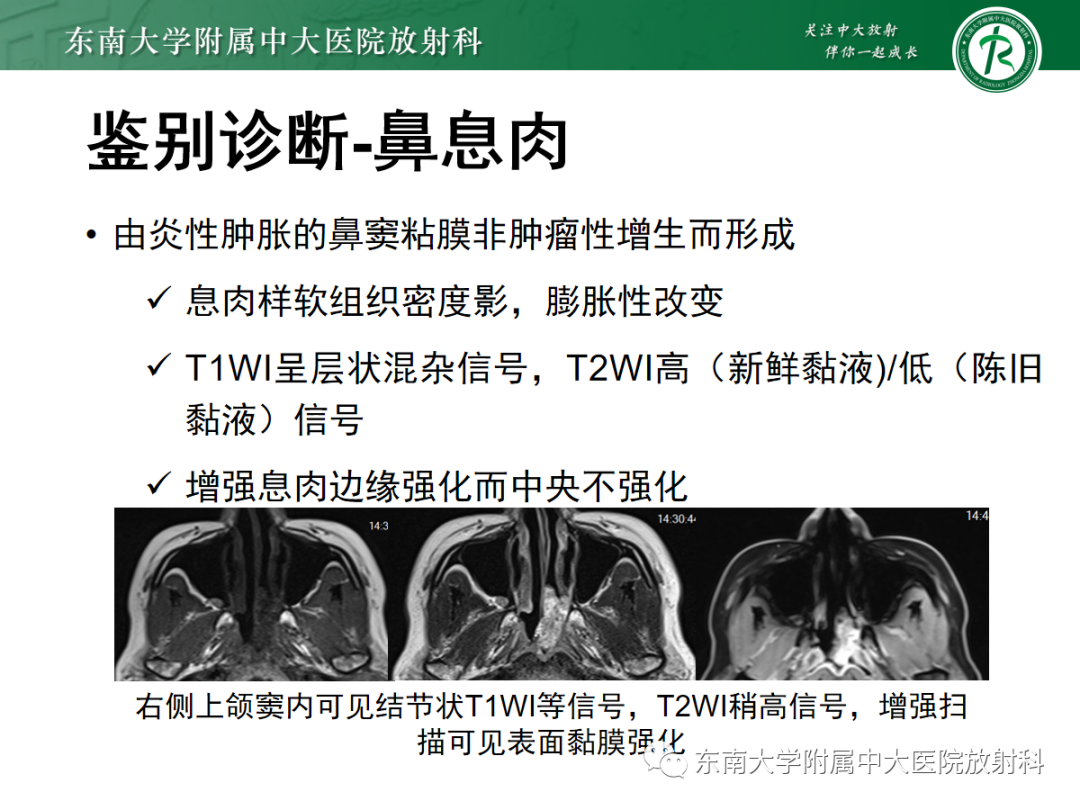 影像PPT - 【PPT】嗅神经母细胞瘤-22