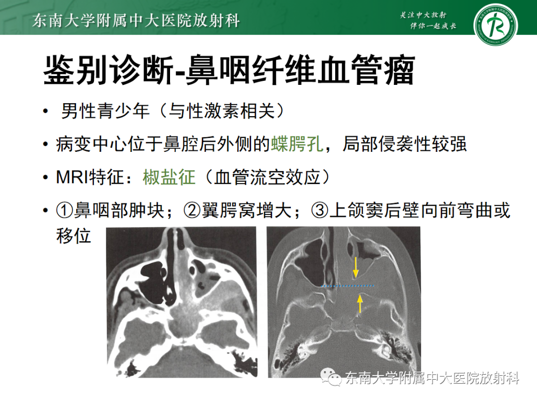 影像PPT - 【PPT】嗅神经母细胞瘤-23