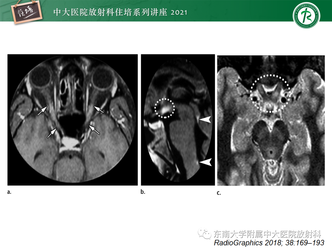 影像PPT - 【PPT】视神经脊髓炎谱系疾病影像表现及鉴别诊断-10