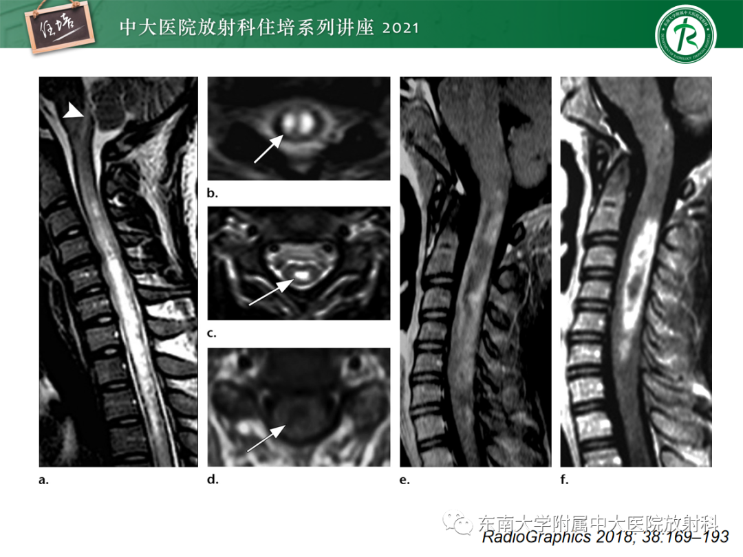影像PPT - 【PPT】视神经脊髓炎谱系疾病影像表现及鉴别诊断-13