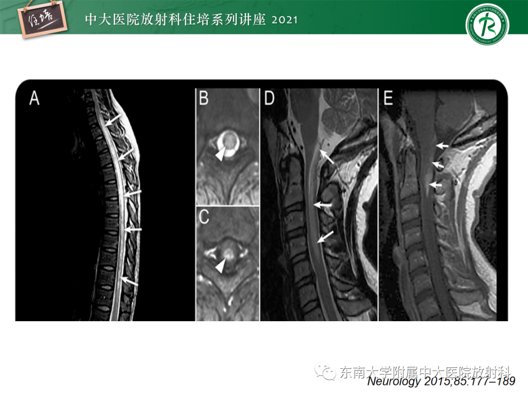 影像PPT - 【PPT】视神经脊髓炎谱系疾病影像表现及鉴别诊断-14