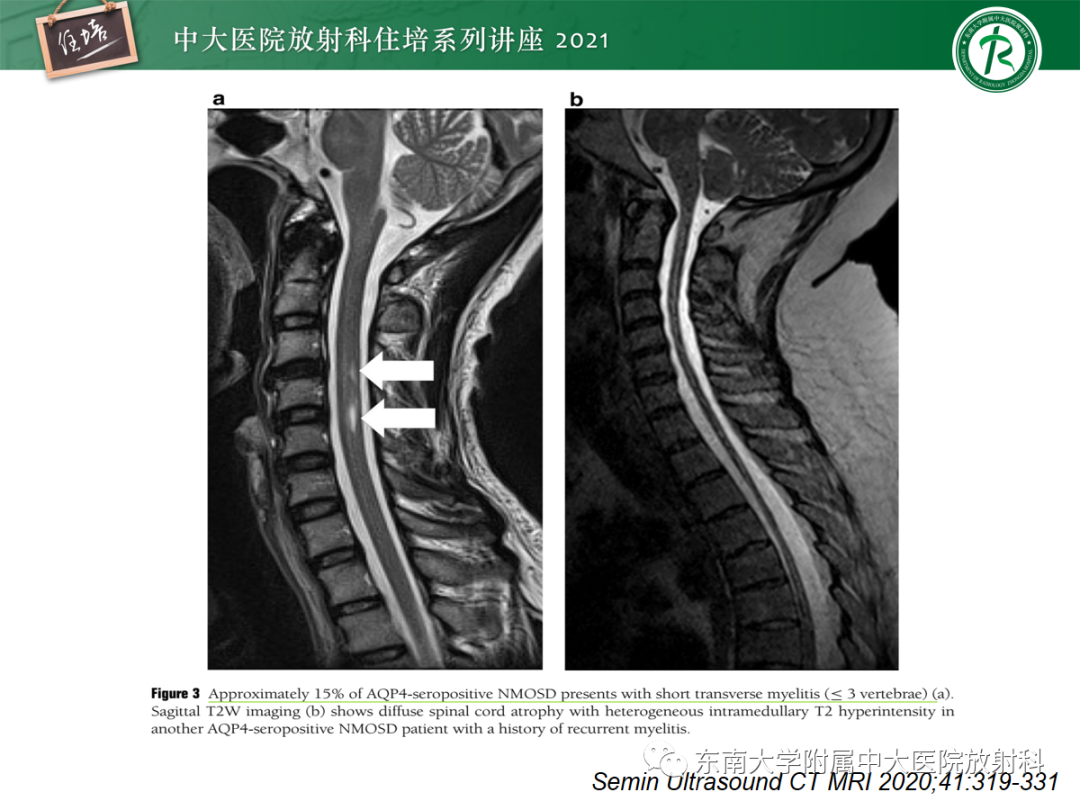 影像PPT - 【PPT】视神经脊髓炎谱系疾病影像表现及鉴别诊断-15