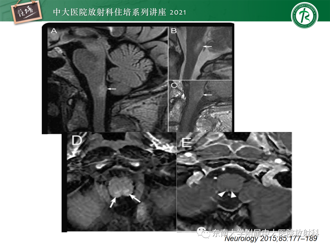 影像PPT - 【PPT】视神经脊髓炎谱系疾病影像表现及鉴别诊断-17