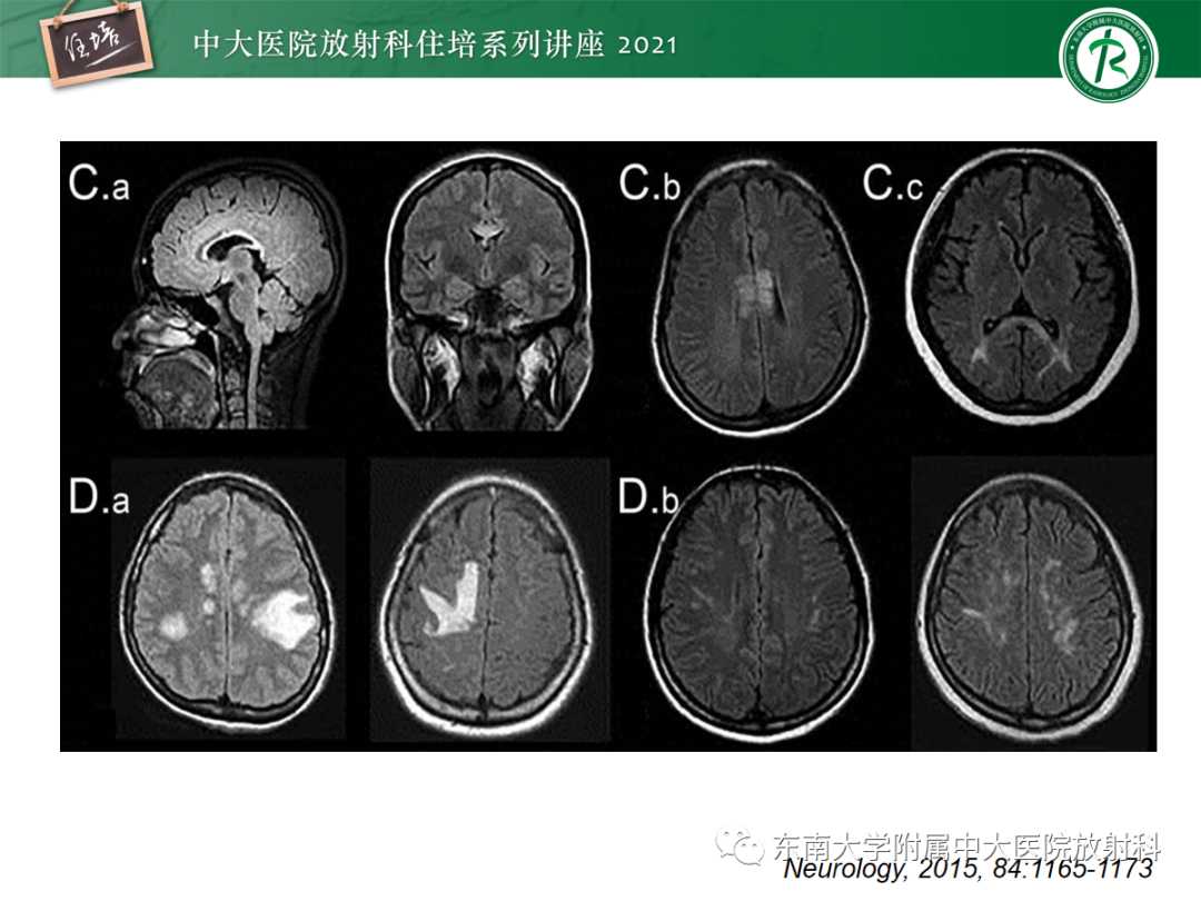 影像PPT - 【PPT】视神经脊髓炎谱系疾病影像表现及鉴别诊断-23