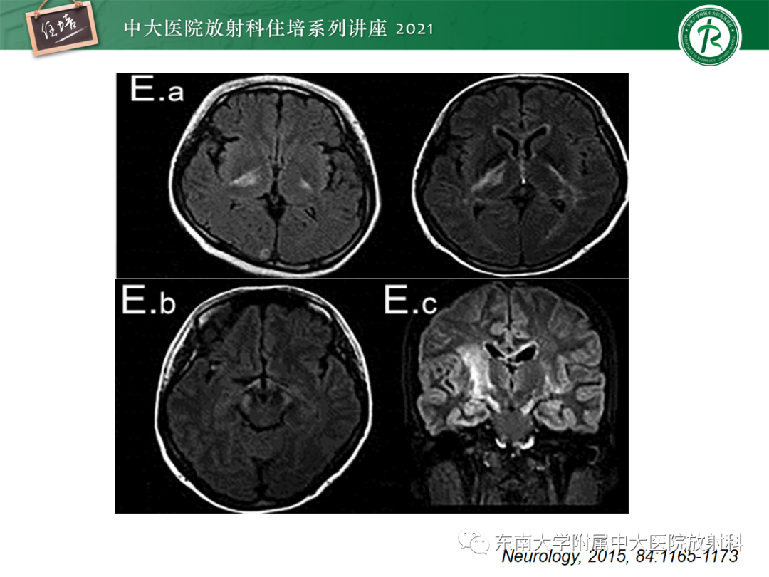 影像PPT - 【PPT】视神经脊髓炎谱系疾病影像表现及鉴别诊断-24